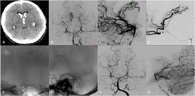 Hemorrhagic Cerebrovascular Pathology in the Pediatric Population